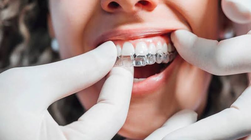 How Much Is Invisalign With Insurance? A Realistic Cost Breakdown
